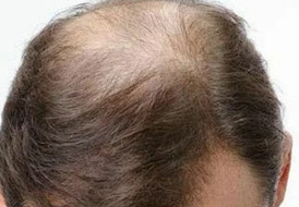 别信 “老了就该秃”！唯秦秘大健康AI养发用专利打破行业界限